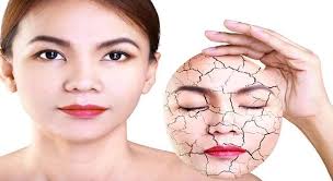 Bài thuốc phòng và trị da khô nứt nẻ